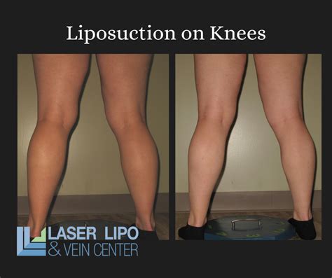 liposuction cost st louis|Liposuction 